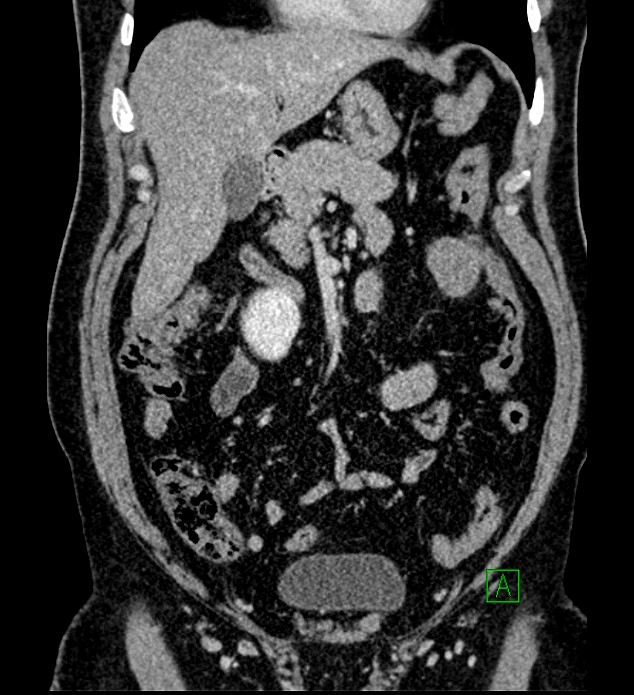 Chromophobe renal cell carcinoma (Radiopaedia 84286-99573 H 64).jpg