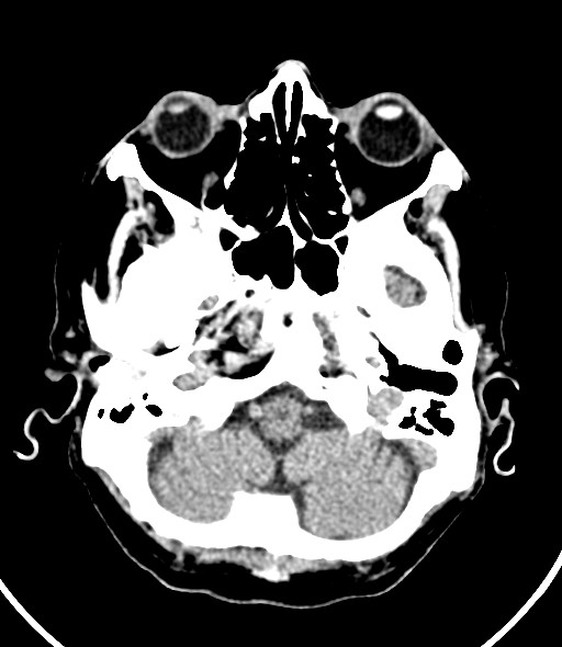 Chronic bilateral subdural hygroma (Radiopaedia 85801-101623 Axial non-contrast 50).jpg