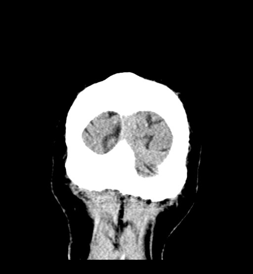 Chronic bilateral subdural hygroma (Radiopaedia 85801-101623 B 12).jpg