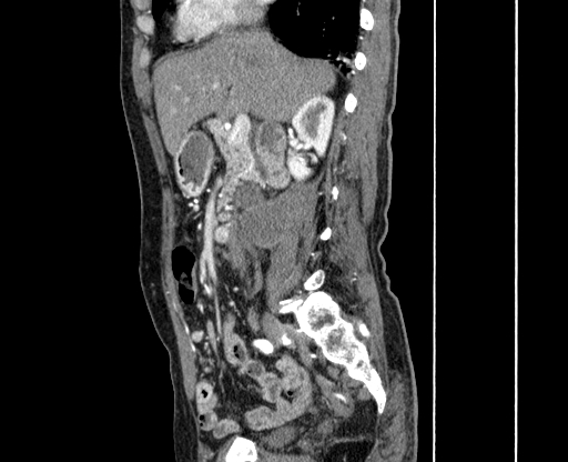 File:Chronic contained rupture of abdominal aortic aneurysm with extensive erosion of the vertebral bodies (Radiopaedia 55450-61901 B 11).jpg