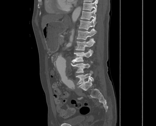 File:Chronic contained rupture of abdominal aortic aneurysm with extensive erosion of the vertebral bodies (Radiopaedia 55450-61901 Sagittal bone window 35).jpg