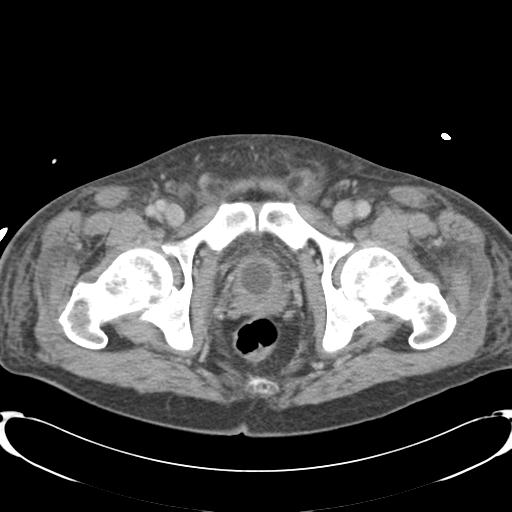 Chronic diverticulitis complicated by hepatic abscess and portal vein thrombosis (Radiopaedia 30301-30938 A 90).jpg
