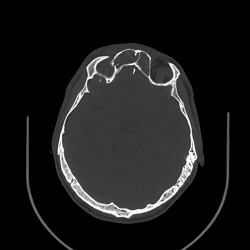 Chronic invasive fungal sinusitis (Radiopaedia 50342-55710 Axial bone window 106).jpg