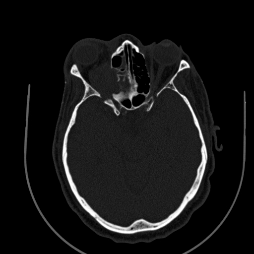 Chronic invasive fungal sinusitis (Radiopaedia 91563-109286 Axial sinus 95).jpg