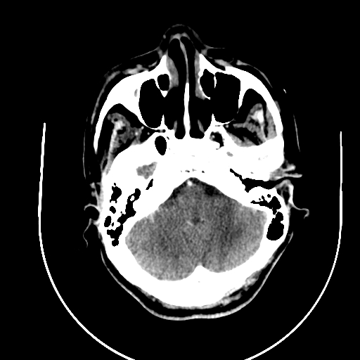 File:Chronic invasive fungal sinusitis (Radiopaedia 91563-109286 B 16).jpg