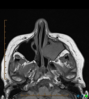 File:Chronic invasive fungal sinusitis with mycetoma (Radiopaedia 27430-27627 Axial T1 1).jpg