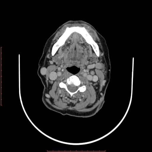 File:Chronic osteomyelitis - maxilla (Radiopaedia 23783-23927 B 11).jpg