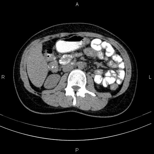 Chronic pancreatitis (Radiopaedia 64576-73450 Axial non-contrast 75).jpg