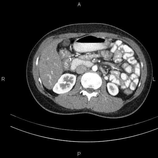 File:Chronic pancreatitis (Radiopaedia 64576-73450 B 70).jpg