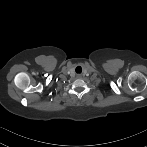 Chronic pulmonary embolus (Radiopaedia 39129-41341 Axial C+ CTPA 5).png
