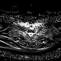 File:Chronic submandibular sialadenitis (Radiopaedia 61852-69885 Axial ADC 27).jpg