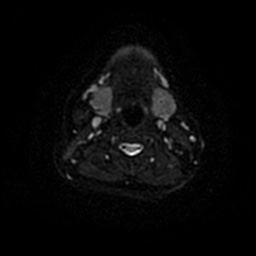 Chronic submandibular sialadenitis (Radiopaedia 61852-69885 Axial DWI 46).jpg