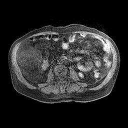 Cirrhosis and hepatocellular carcinoma in the setting of hemochromatosis (Radiopaedia 75394-86594 Axial T1 C+ fat sat 1).jpg