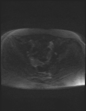 File:Class II Mullerian duct anomaly- unicornuate uterus with rudimentary horn and non-communicating cavity (Radiopaedia 39441-41755 Axial DWI 77).jpg
