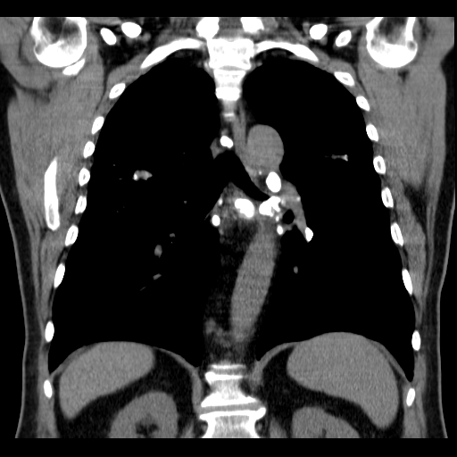Classic complicated silicosis (Radiopaedia 49720-54961 Coronal liver window 39).jpg