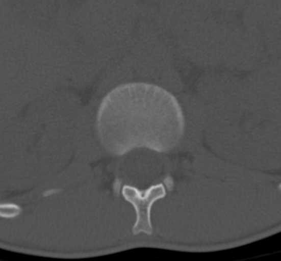 Clear cell meningoma - lumbar spine (Radiopaedia 60116-67691 Axial bone window 10).png