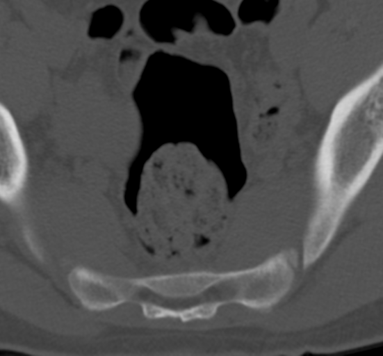 Clear cell meningoma - lumbar spine (Radiopaedia 60116-67691 Axial bone window 84).png