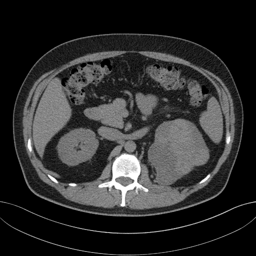 File:Clear cell renal cell carcinoma (Radiopaedia 61449-69393 Axial non-contrast 28).jpg