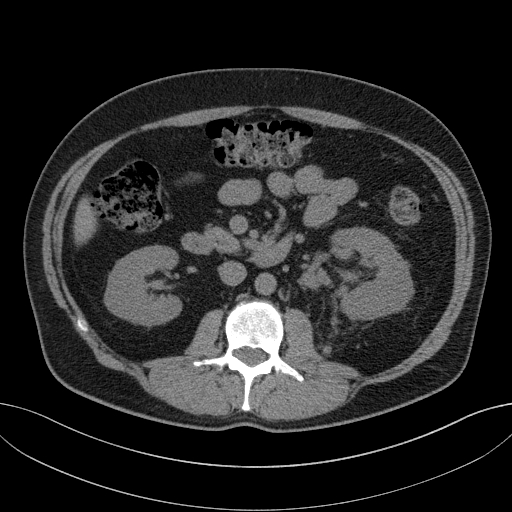 File:Clear cell renal cell carcinoma (Radiopaedia 61449-69393 Axial non-contrast 41).jpg