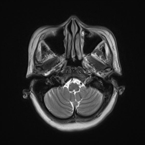 File:Clival meningioma (Radiopaedia 53278-59248 Axial T2 3).jpg
