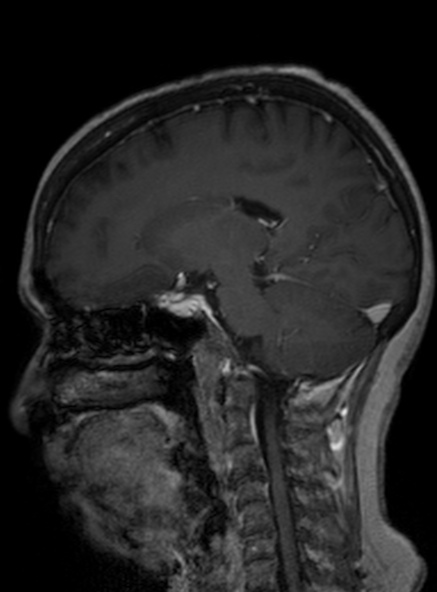 Clival meningioma (Radiopaedia 53278-59248 Sagittal T1 C+ 235).jpg
