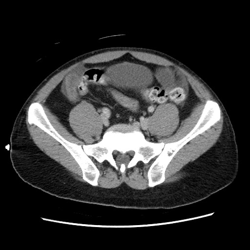 File:Closed-loop small bowel obstruction (Radiopaedia 73713-84509 A 122).jpg