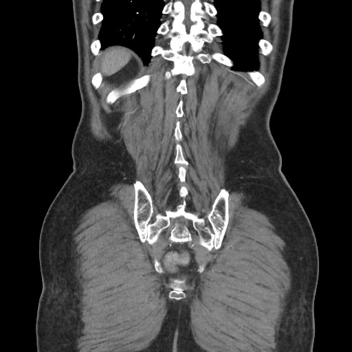 File:Closed loop obstruction due to adhesive band, resulting in small bowel ischemia and resection (Radiopaedia 83835-99023 C 107).jpg