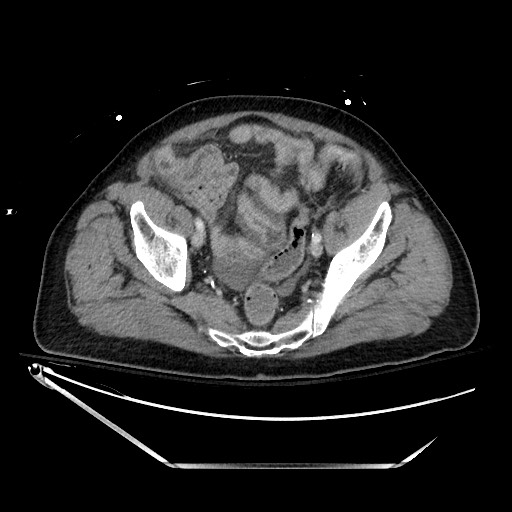 File:Closed loop obstruction due to adhesive band, resulting in small bowel ischemia and resection (Radiopaedia 83835-99023 D 129).jpg