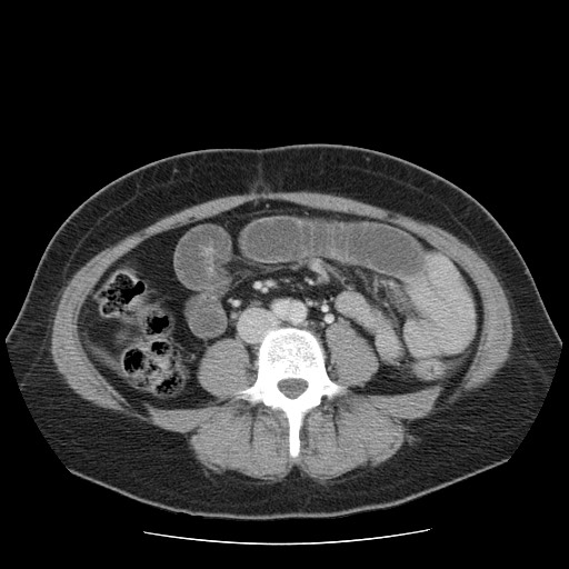 File:Closed loop small bowel obstruction (Radiopaedia 65403-74451 A 46).jpg