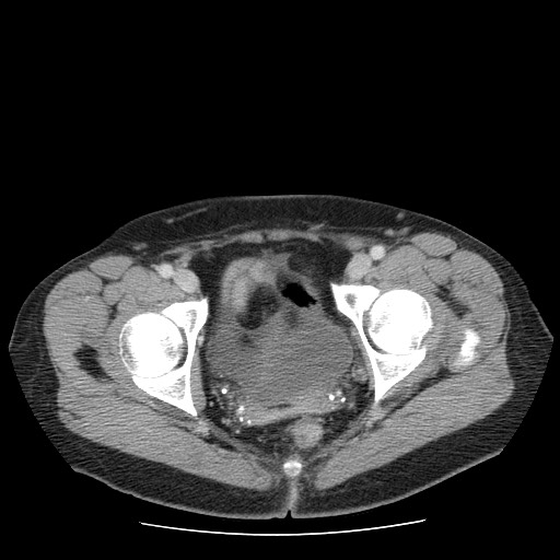 File:Closed loop small bowel obstruction (Radiopaedia 65403-74451 Axial 56).jpg