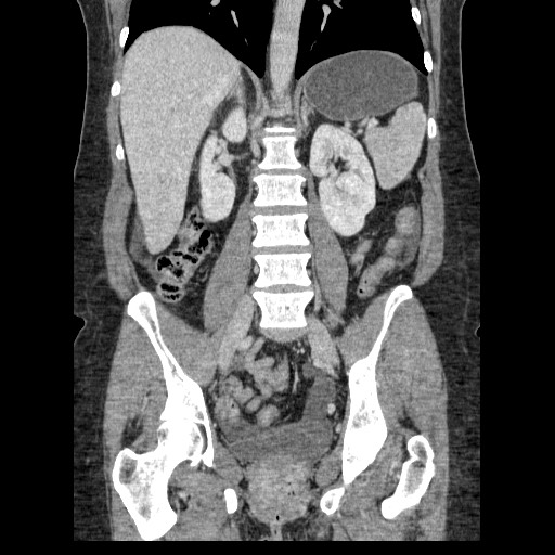 Closed loop small bowel obstruction (Radiopaedia 65403-74451 B 67).jpg