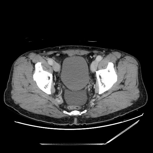 File:Closed loop small bowel obstruction - omental adhesion causing "internal hernia" (Radiopaedia 85129-100682 A 151).jpg