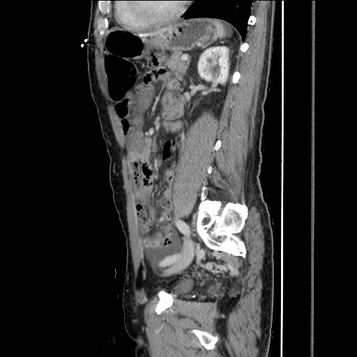 File:Closed loop small bowel obstruction - omental adhesion causing "internal hernia" (Radiopaedia 85129-100682 C 116).jpg