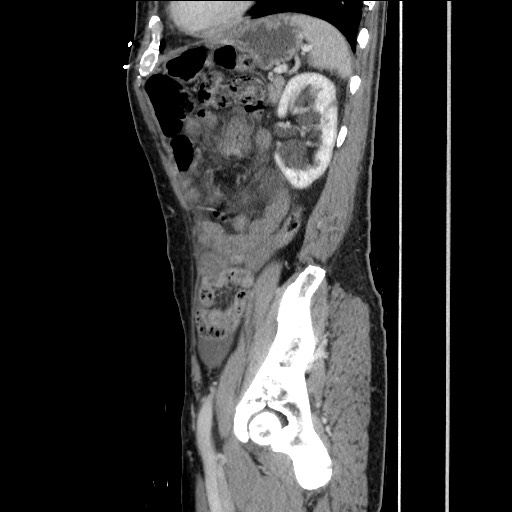 Closed loop small bowel obstruction - omental adhesion causing "internal hernia" (Radiopaedia 85129-100682 C 132).jpg