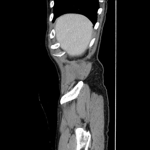 Closed loop small bowel obstruction - omental adhesion causing "internal hernia" (Radiopaedia 85129-100682 C 33).jpg