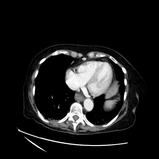 File:Closed loop small bowel obstruction due to adhesive band, with intramural hemorrhage and ischemia (Radiopaedia 83831-99017 Axial 137).jpg