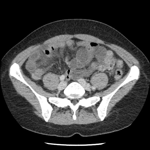File:Closed loop small bowel obstruction due to trans-omental herniation (Radiopaedia 35593-37109 A 60).jpg