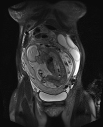 File:Closed loop small bowel obstruction in pregnancy (MRI) (Radiopaedia 87637-104031 Coronal T2 fat sat 19).jpg