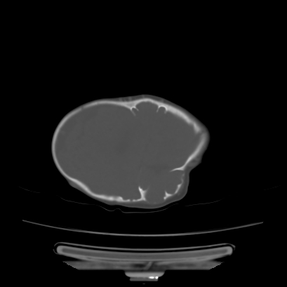 Cloverleaf skull (Radiopaedia 91901-109710 Axial bone window 122).jpg