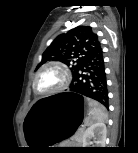 Coarctation of aorta (Radiopaedia 27427-27622 Sagittal C+ CTPA 105).png