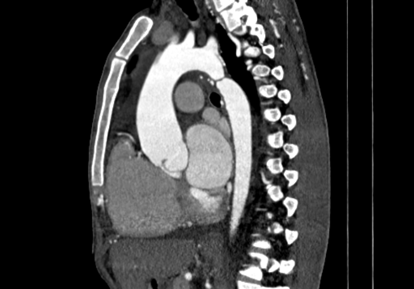 Coarctation of aorta with aortic valve stenosis (Radiopaedia 70463-80574 B 74).jpg