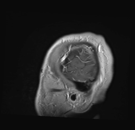File:Cochlear incomplete partition type III associated with hypothalamic hamartoma (Radiopaedia 88756-105498 Sagittal T1 C+ 50).jpg