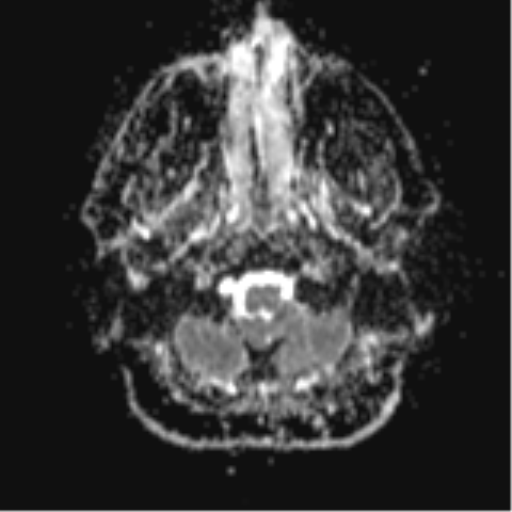 File:Colloid cyst (Radiopaedia 44510-48181 Axial ADC 3).png