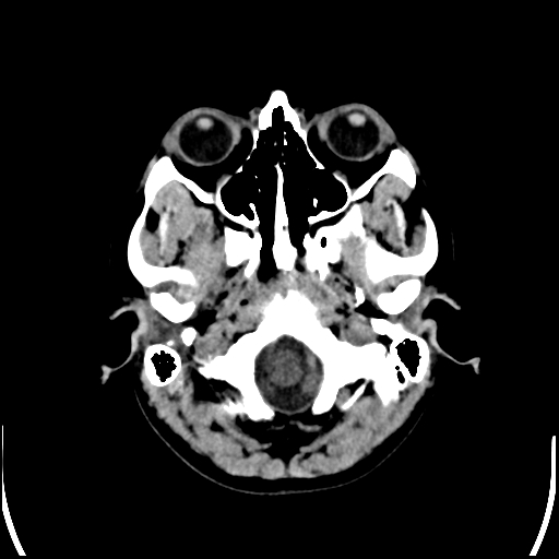 Colloid cyst (Radiopaedia 78104-90633 Axial non-contrast 13).jpg