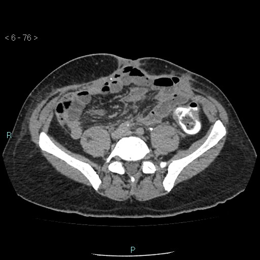 File:Colo-cutaneous fistula (Radiopaedia 40531-43129 A 31).jpg