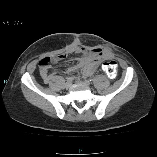 File:Colo-cutaneous fistula (Radiopaedia 40531-43129 A 40).jpg