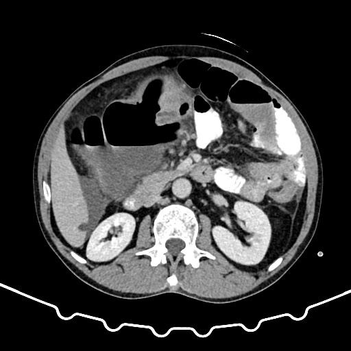 File:Colocolic intussusception due to large lipoma (Radiopaedia 68773-78482 A 72).jpg