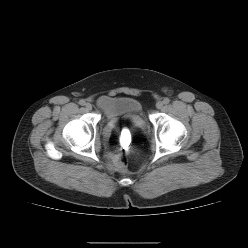 File:Colocutaneous fistula in Crohn's disease (Radiopaedia 29586-30093 D 36).jpg