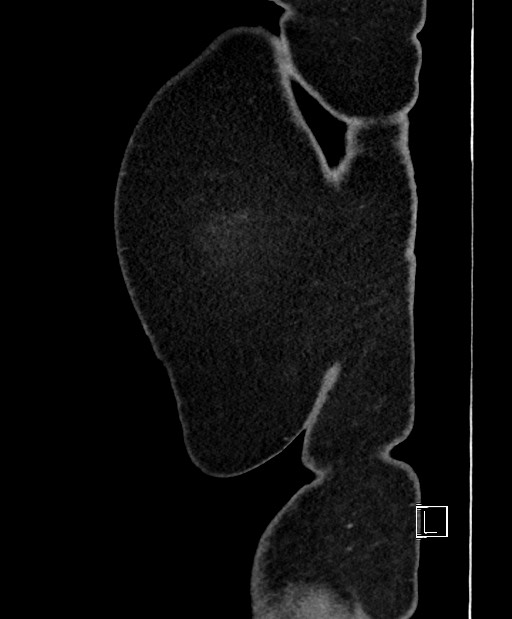 Colon adenocarcinoma (Radiopaedia 59374-66735 C 4).jpg