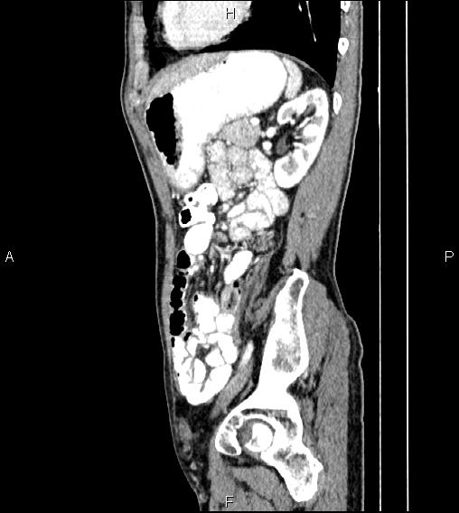 File:Colon adenocarcinoma - hepatic flexure (Radiopaedia 85635-101395 D 64).jpg